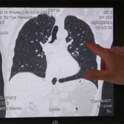 lungs, scanner